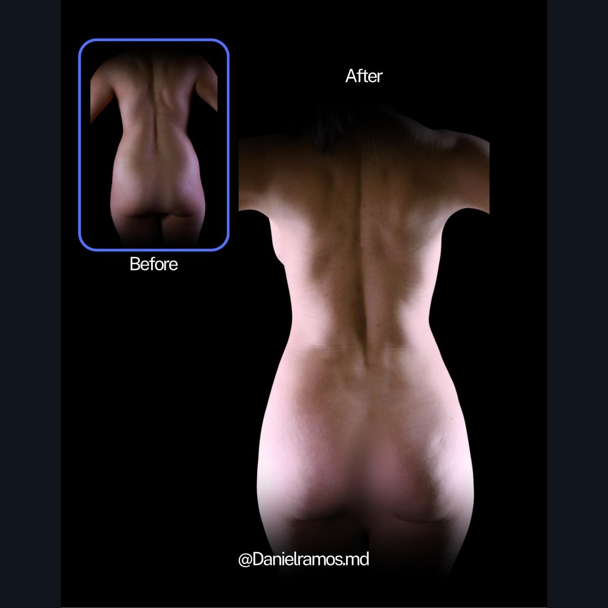 Lipo 360: back and waist contour before and after, Dr. Daniel Ramos, Bogotá