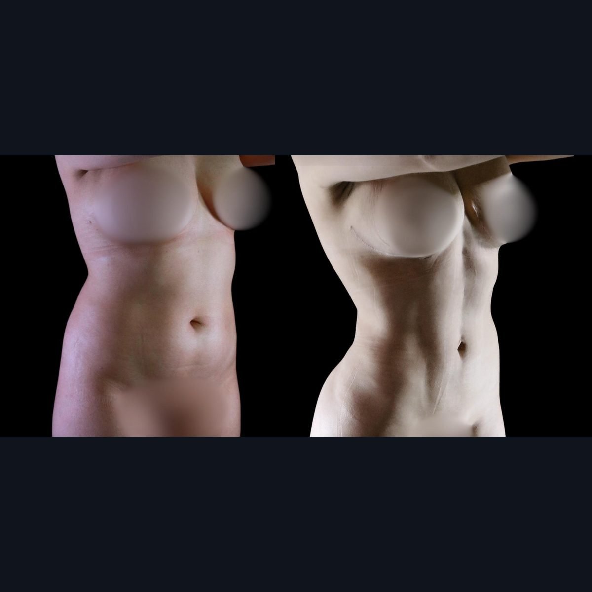 Lipo 360 in Colombia: abdomen and waist before and after high-definition liposculpture
