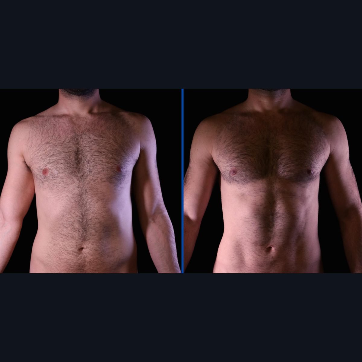 High-definition body contouring for men: abdomen before and after, Bogotá, Colombia