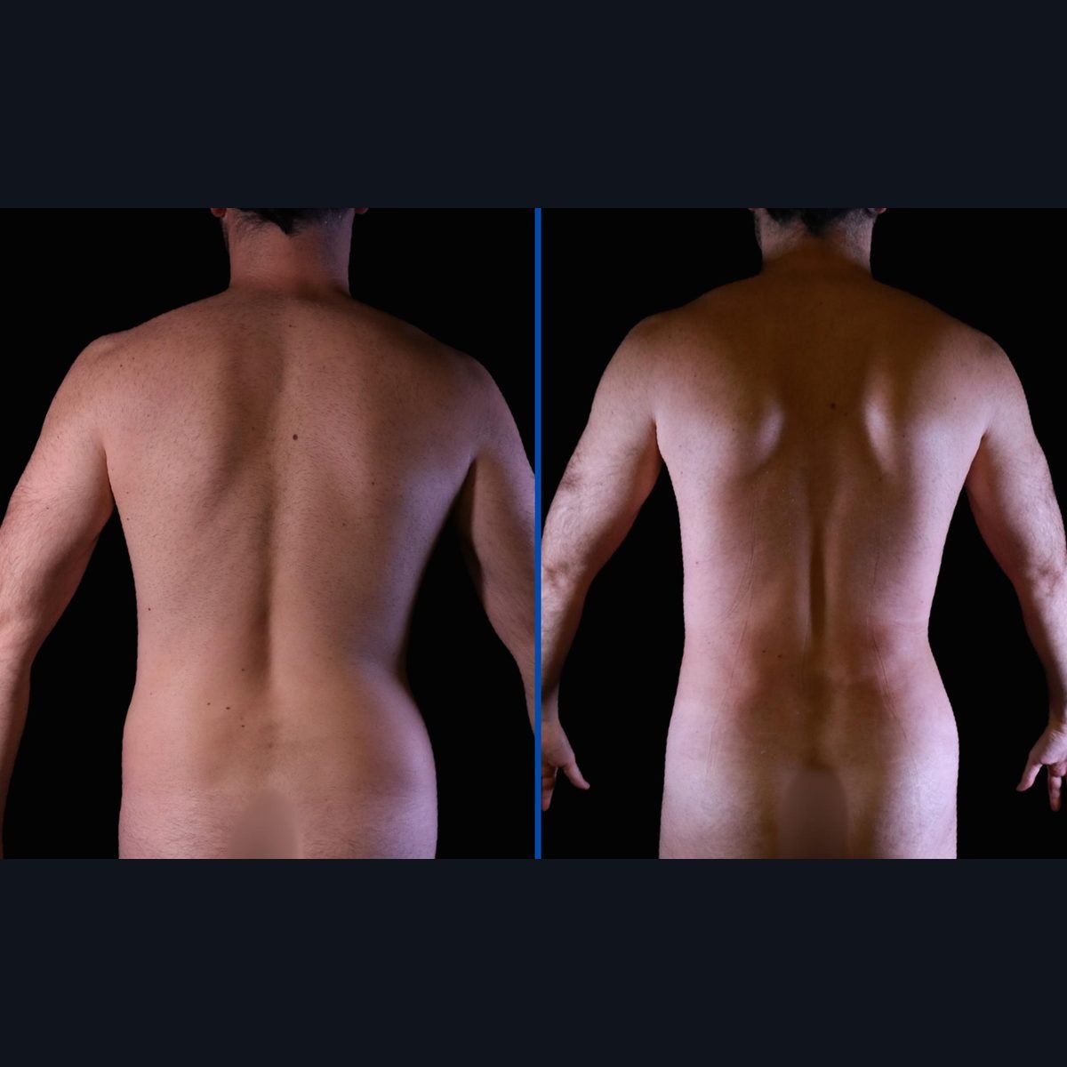 High-definition liposuction for men: back and waist before and after, Bogotá, Colombia