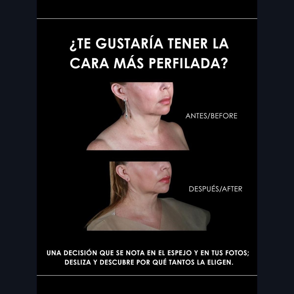 Submental liposuction in Bogotá: facial profile before and after with Dr. Daniel Ramos